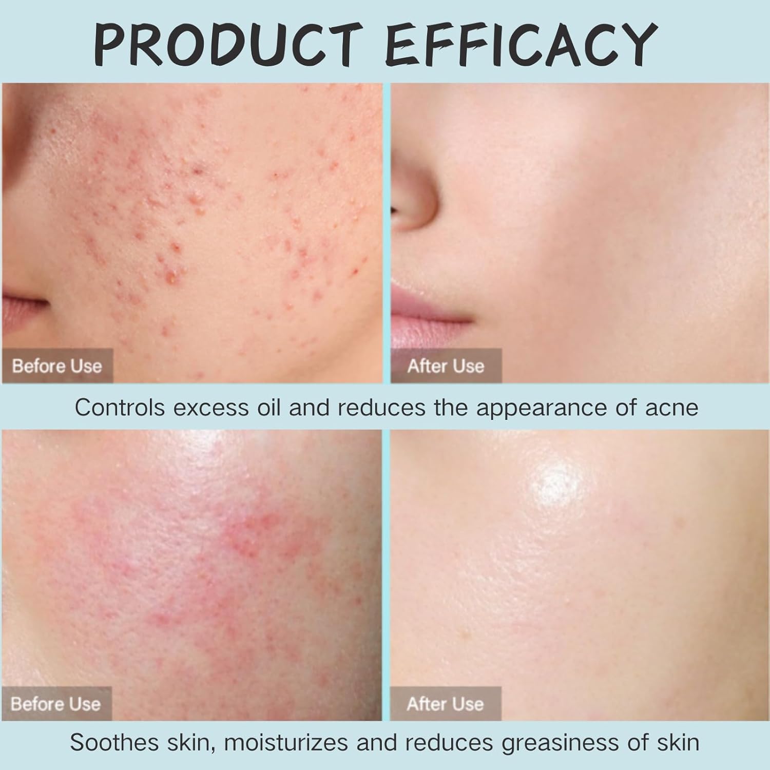 Tea Tree Salicylic Acid Oil Control Acne Removal Set - Prevents Recurrence